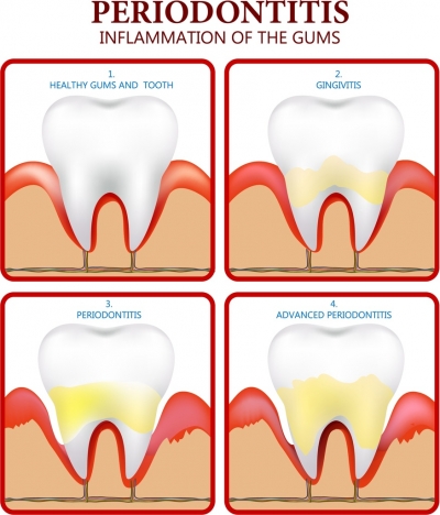 periodontics poster flat colored design tooth icons